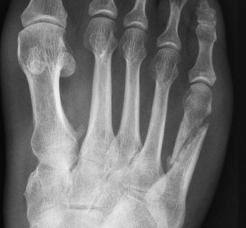 Перелом проксимальной фаланги 1 пястной кости. Краевой перелом основной фаланги 5 пальца кисти. Поднадкостничный перелом основной фаланги. Перелом основной фаланги 4 пальца стопы. Перелом фаланги 5 пальца стопы рентген.