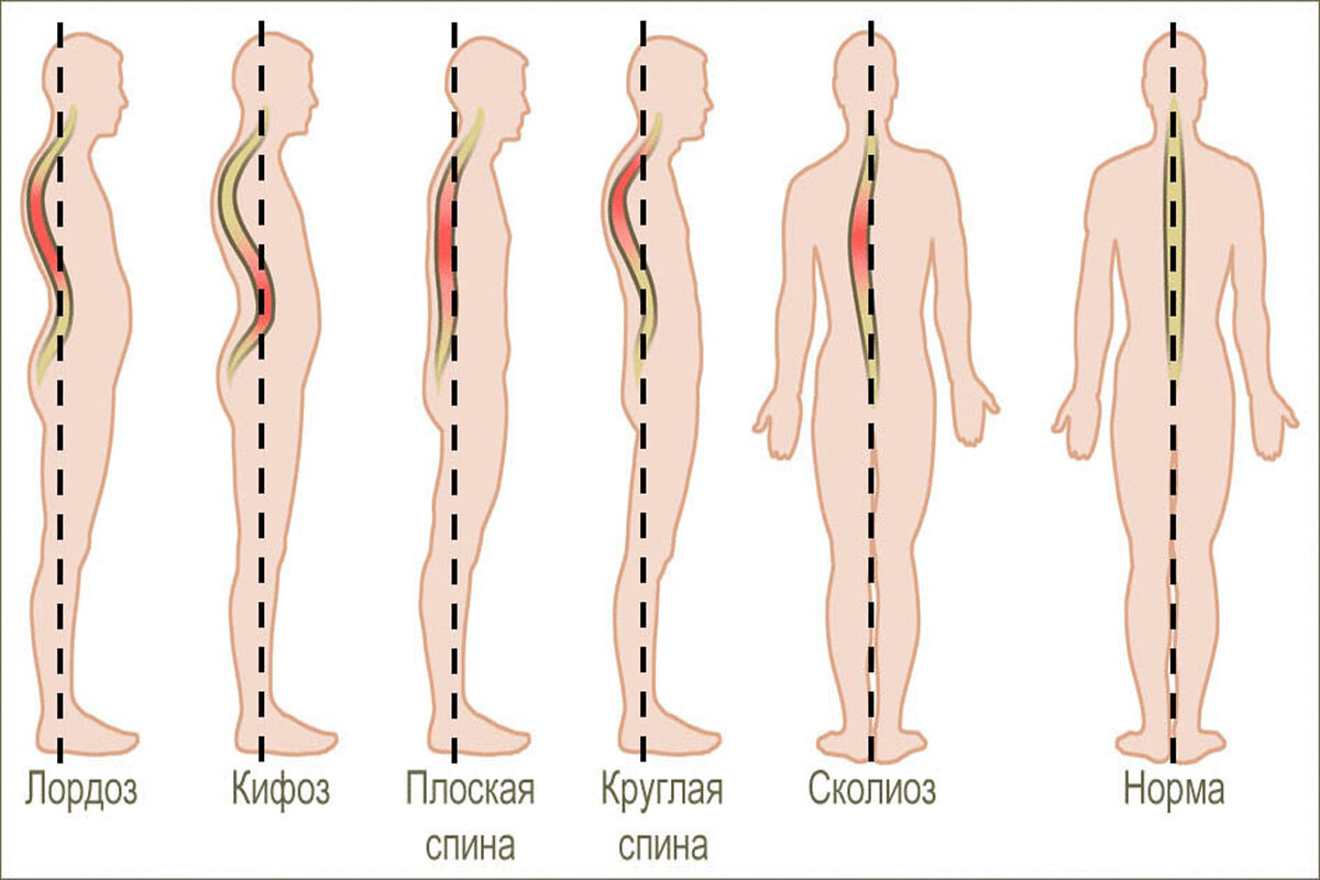 Что такое гиперлордоз и методы его коррекции | Восстановительная медицина |  Дзен