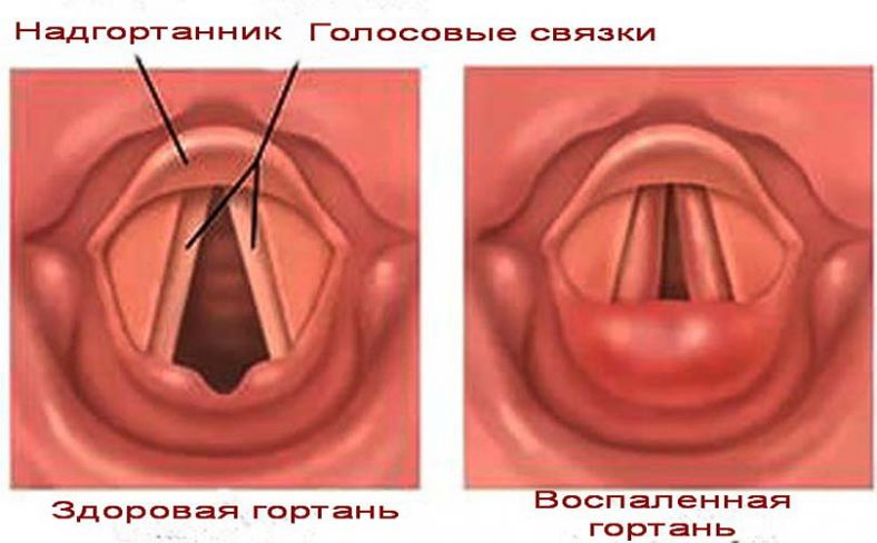 Формы и виды бронхоспазма