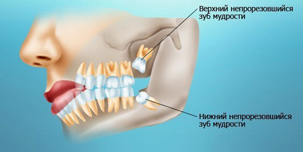 Зубы мудрости картинки