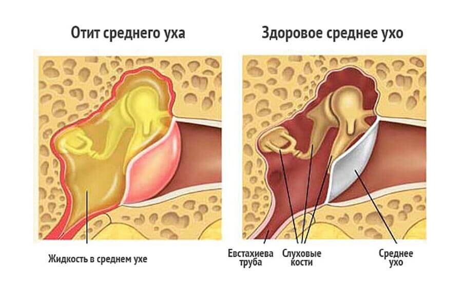 Продувание и пневмомассаж уха