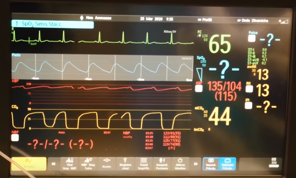 Данные с монитора человека, которого подключили к ИВЛ в отделении интенсивной терапии