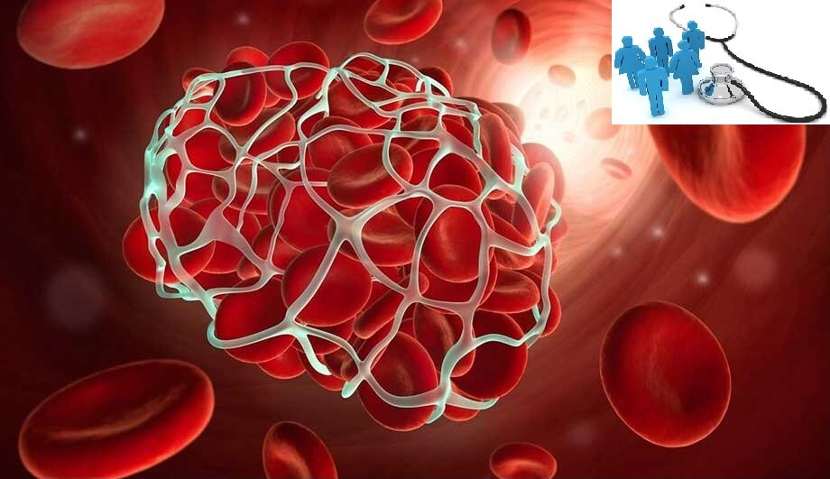 Образовавшийся тромб