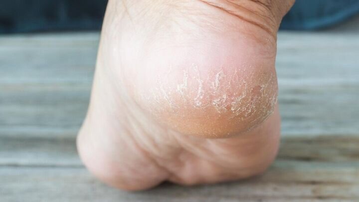 Сухая кожа стоп