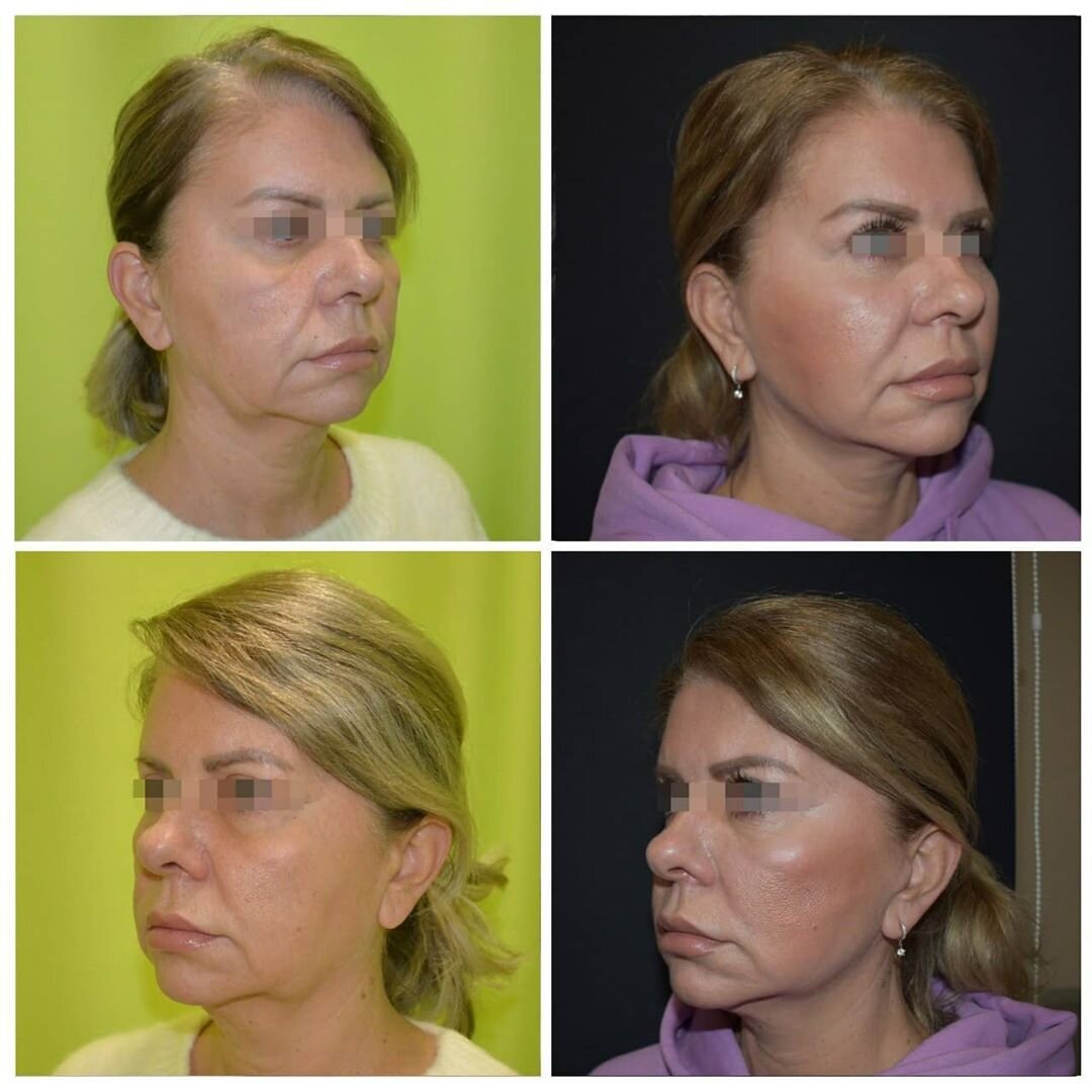 Женщины 40+ до и после подтяжки лица: разбор фото реальных пациентов |  TecRussia.ru | Дзен