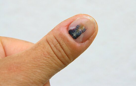 Почерневшие от сильного ушиба или защемления ногти. Источник: felipeborba.com.br