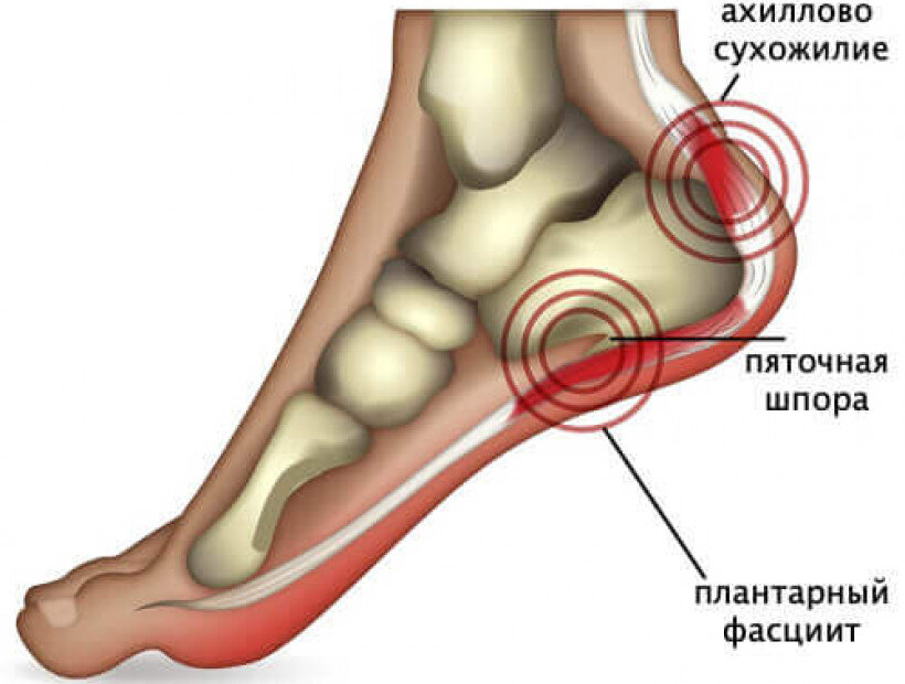 Под пяточная шпора. Под пяточная шпора. Неврома в области плантарного фасцита стопы. Плацентарный фасциит стопа. Подошвенная фасция стопы.