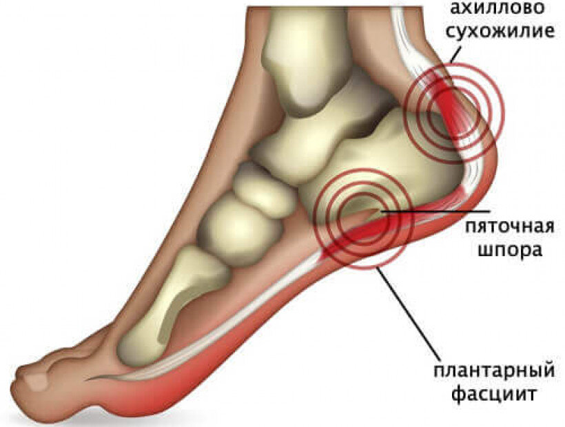 Плацентарный фасциит стопа. Подошвенный, или плантарный фасциит. Подошвенная пяточная шпора. Плантарный фасциит пятки.