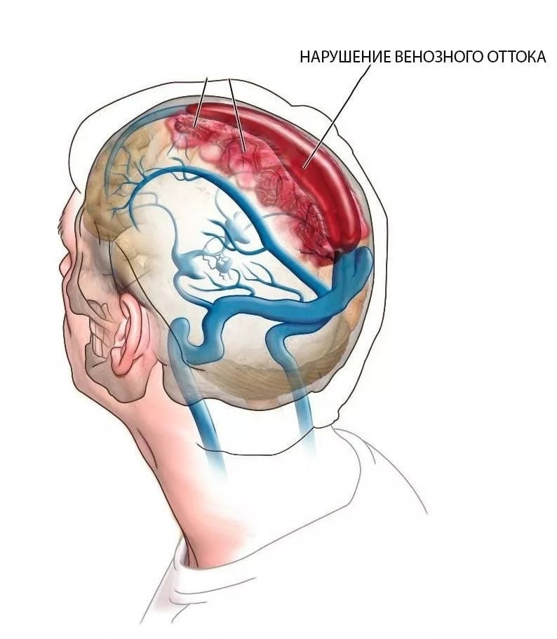 Жидкость в голове. Нарушение венозного оттока головного. Венозный отток головного мозга. Нарушение венозного оттока головного мозга. Отток венозной крови от головы.
