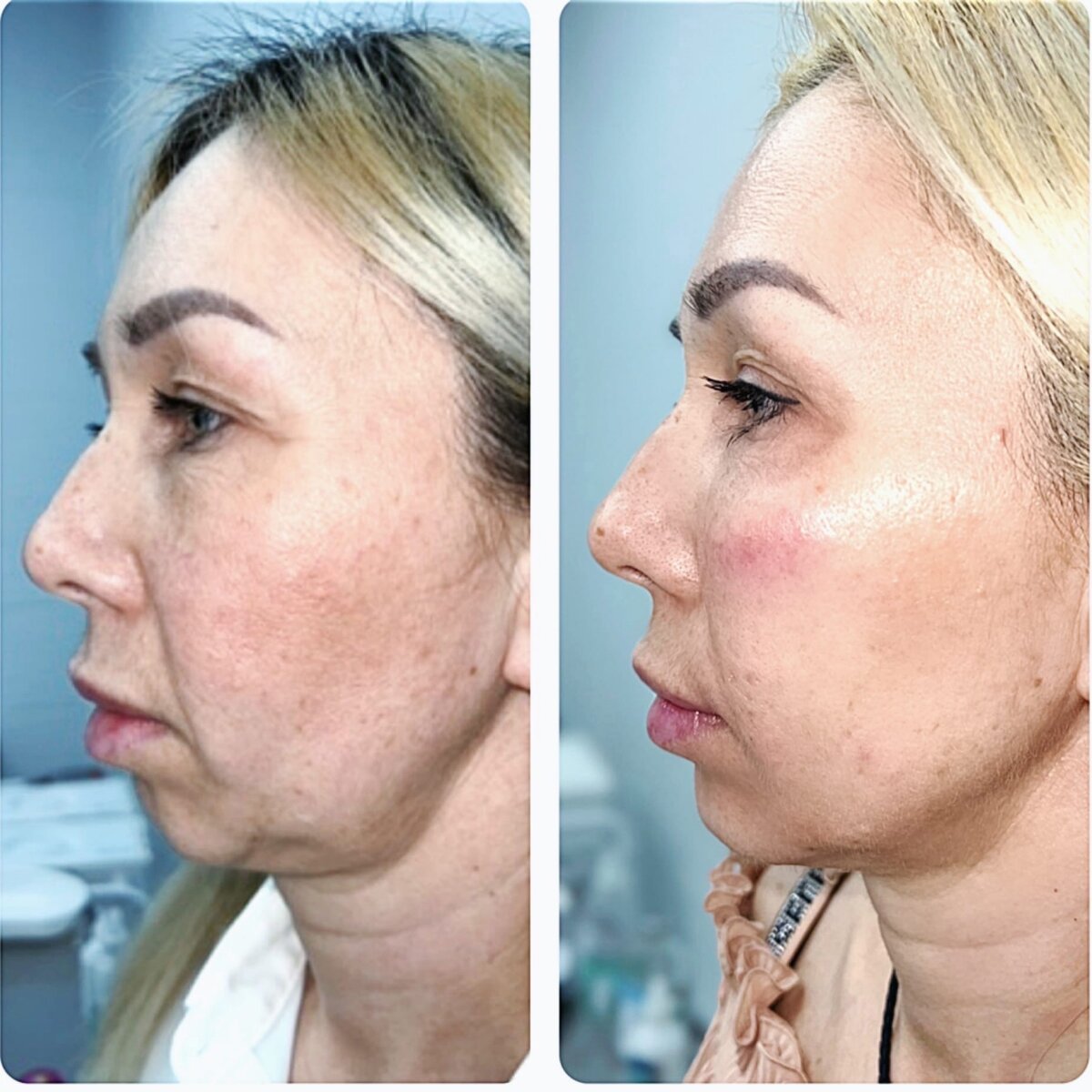 Контурная пластика области скул, уменьшение носогубной складки