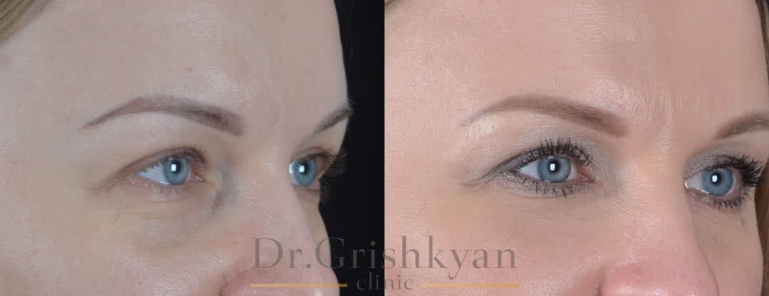 Липофилинг носослезной борозды фото до и после. Фото с сайта Д.Р. Гришкяна. Имеются противопоказания, требуется консультация специалиста