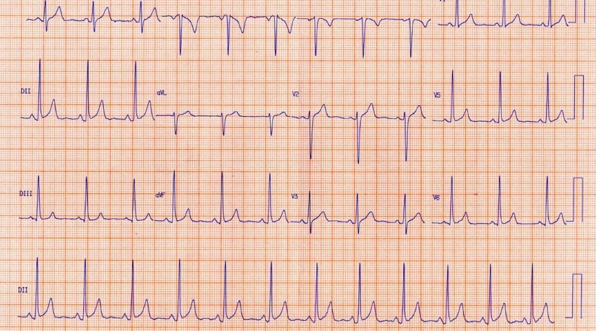 Дела сердечные. Кардиолог о том, как распознать инфаркт миокарда ...
