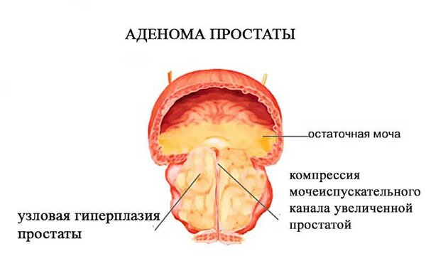 Проводим профилактику простатита и аденомы простаты в домашних условиях для мужчин за 50.