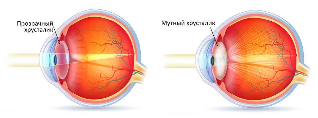 При катаракте мутнеет естественная линза глаза
