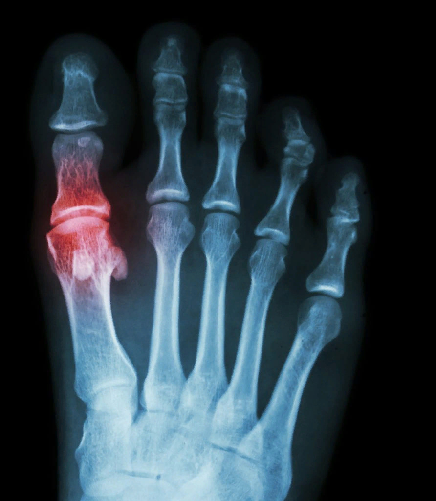 Основание подагры