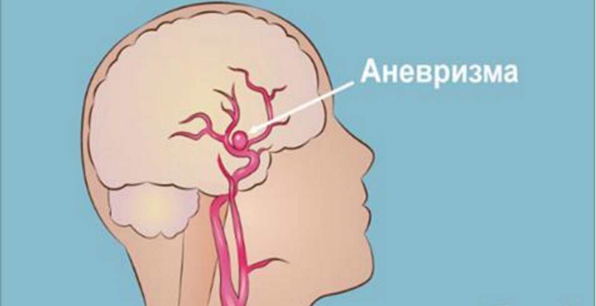 Аневризма мозга симптомы. Аневризма головного мозга. Аневризм головного мозга. Разрыв аневризмы головного мозга. Микроаневризма сосудов головного.