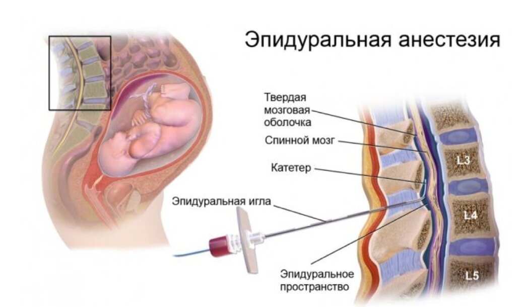 Кесарево сечение (оперативные роды)