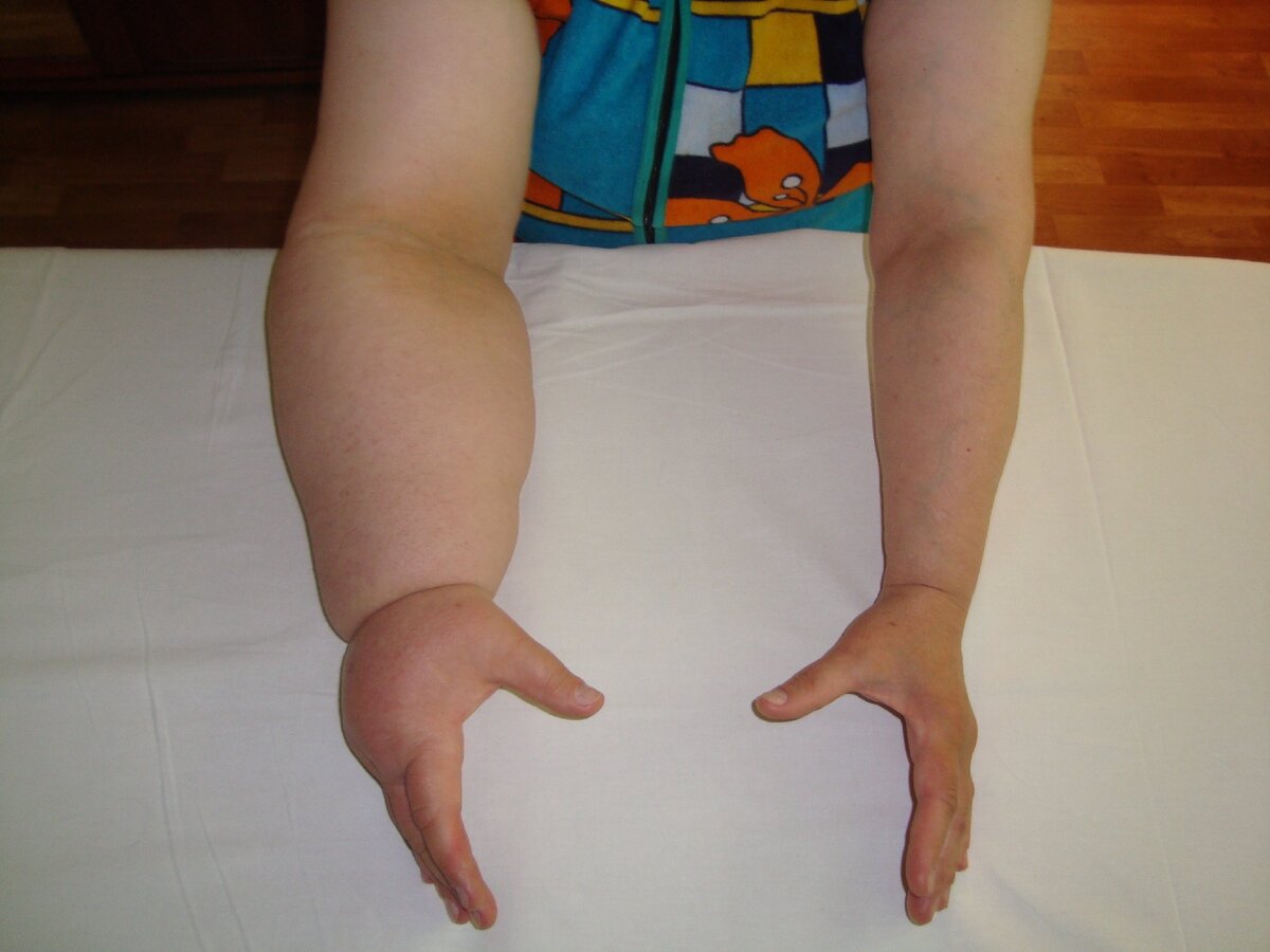 Лимфедема или лимфостаз правой руки. Фото носит иллюстративный характер. Источник фото: Яндекс картинки