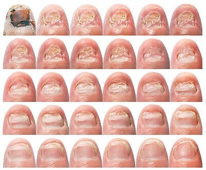 Грибок ногтей на разных стадиях