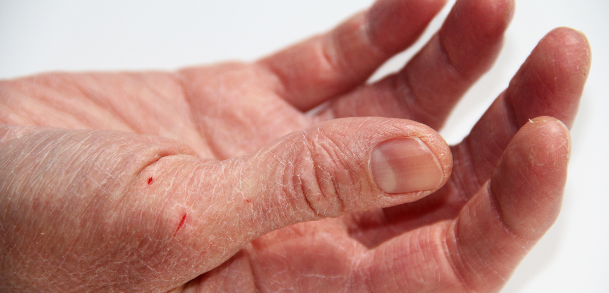 При сухости на коже рук появляются трещины