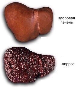 Цирроз печени: стадии

Цирроз печени – это хроническое прогрессирующее заболевание, при котором здоровые ткани органа замещаются фиброзными (рубцовыми), нарушая функции печени и меняя ее размеры и даже местоположение.1Цирроз является конечной стадией ряда хронических заболеваний печении сам в своем развитии подразделяется на несколько стадий.

❗️1 стадия

Стадия компенсации. Печень еще выполняет свои функции почти в полном объеме за счет здоровых клеток, которые работают в усиленном режиме, пытаясь компенсировать пока незначительное замещение здоровой ткани на рубцовую.

📌Выраженных симптомов на этой стадии нет, поэтому определить ее можно только с помощью лабораторных анализов, в частности, биохимического анализа крови.2

📌Среди показателей, которые могут стать маркёрами поражения печени важно отметить:

– альбумин;
– глутамилтранспептидаза;
– глутаминовая оксалоуксусная трансаминаза;
– глутаминовая пируваттрансаминаза;
– протромбиновое время;
– билирубин;
– уровень тромбоцитов;
– средний объём клеток крови.

Список необходимых исследований назначается вашим лечащим врачом, как и дальнейшее необходимое лечение. Чтобы своевременно выявить болезнь достаточно регулярно проходить обследование.

📌2 стадия

Стадия субкомпенсации наступает, когда здоровые клетки печениисчерпывают свои ресурсы и более не справляются с повышенной нагрузкой. Здесь симптомы цирроза становятся более явными, но заболевание все еще успешно поддается медикаментозному лечению.

❗️Наиболее распространенные симптомы:

– головные боли;
– снижение аппетита;
– тошнота;
– расстройства стула (диарея);
– дискомфорт в правом боку;
– кровоточивость десен и частые кровотечения из носа;
– сосудистые звездочки и синяки, появляющиеся даже при незначительном надавливании на кожу.

❗️Цирроз печени на стадии субкомпенсации также может проявить себя в зависимости от пола больного: у мужчин отмечается гинекомастия и алопеция, а у женщин – расстройства менструального цикла.3

Лабораторные анализы при этом демонстрируют ухудшение состояния: показатели уровня альбумина становятся ниже, протромбиновый индекс также снижается.

📌3 стадия

Стадия декомпенсации наступает, когда значительный объем тканей печени заменяется рубцовой, что приводит к печеночной недостаточности.4 Цирроз здесь имеет выраженные признаки и требует немедленной госпитализации.

❗️❗️❗️Симптомы:

– пожелтение кожных покровов и белков глаз;
– частая рвота;
– сильное увеличение живота, вызванное скоплением жидкости (асцит);
– значительное повышение или снижение температуры тела ниже 35,5°С;
– сильная слабость, вызванная атрофией мышц.

📌Без срочного лечения цирроз в стадии декомпенсации может вызвать внутренние кровотечения, печеночную кому, тромбоз, рак печени, присоединение вторичной инфекции, заболевания дыхательных путей.

📌Лабораторные исследования свидетельствуют о тяжелейших нарушениях работы печени. Протромбиновый индекс, альбумин, а также гемоглобин становятся очень низкими, и кроме основных изменений формируется анемия.1

📌Прогноз по циррозу в стадии декомпенсации не очень благоприятный - 60% пациентов с диагностированной 3-ей стадией умирают в течение 3-х лет, однако шанс на выживание есть у каждого.

❗️1. Для того, чтобы определить стадию цирроза печени, необходимо обратиться к специалисту, поскольку сделать это можно лишь с помощью лабораторной диагностики.2

❗️2. Симптомы цирроза печени на начальной стадии могут не проявляться, поэтому так важно проходить регулярные обследования печени каждому, кто заботится о своем здоровье или находится в группе риска по развитию заболевания.