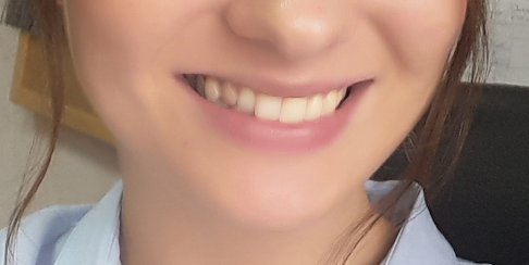 Моя улыбка до брекетов. Нижняя челюсть с одной стороны находится впереди верхней