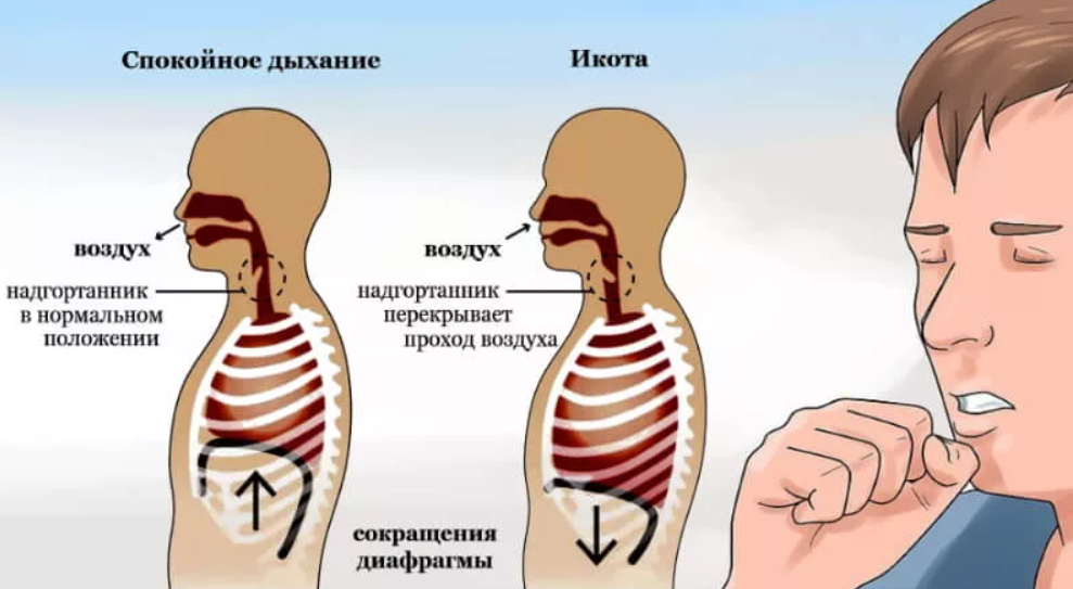 Как перестать икать