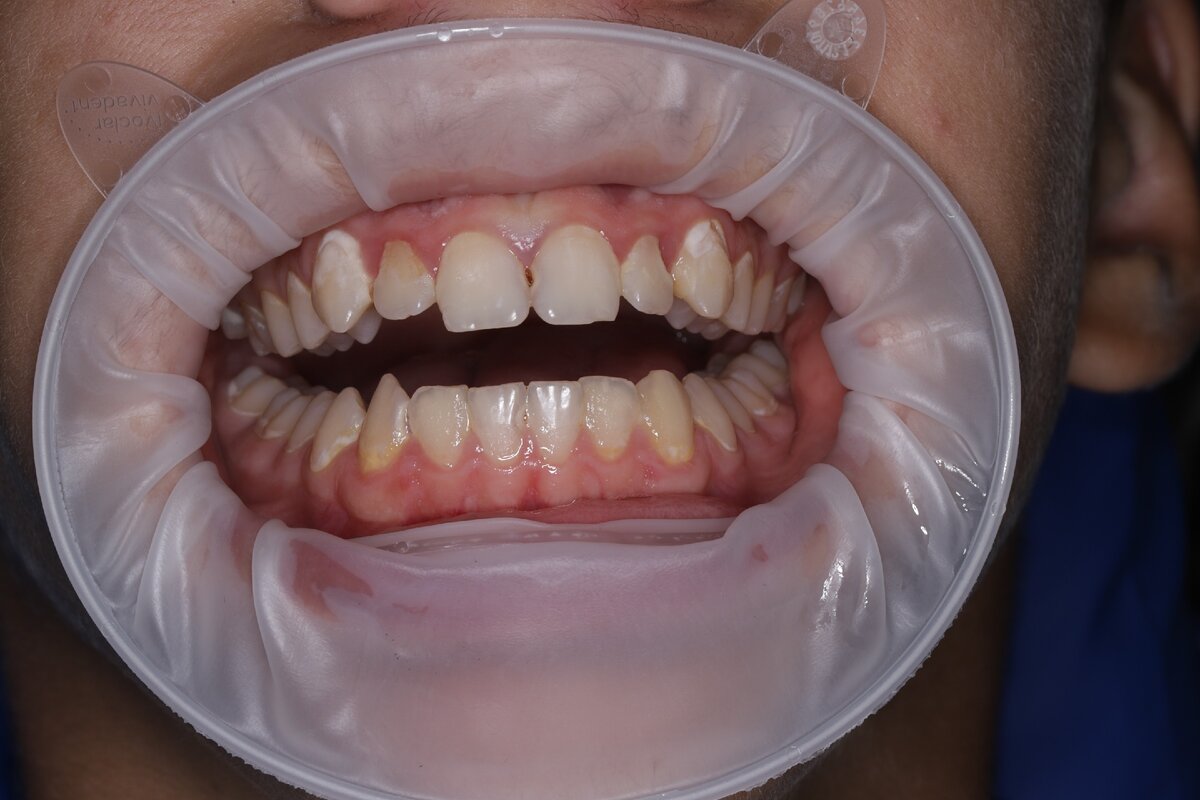 Причины массовой потери зубов