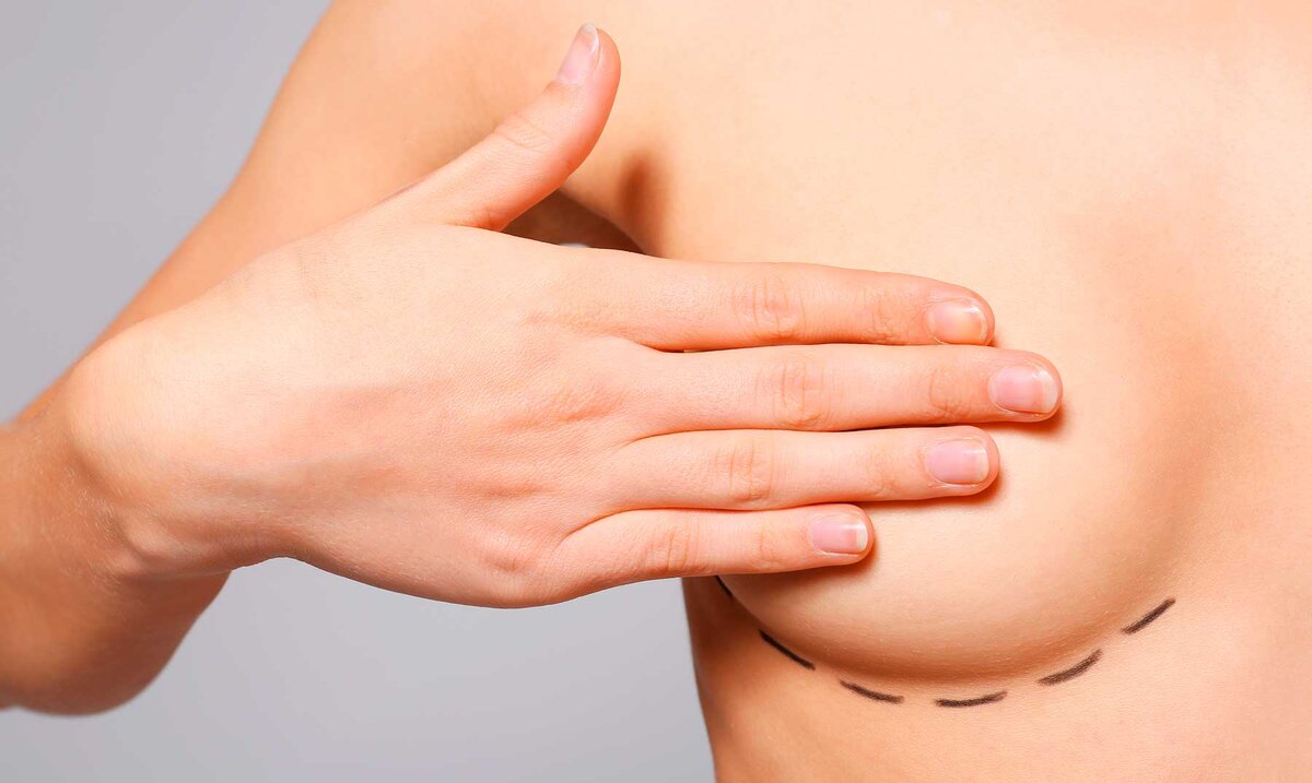 Могут ли грудные имплантаты перевернуться?