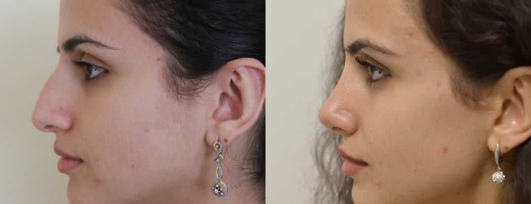 Удаление горбинки носа фото до и после. Фото с сайта Д.Р. Гришкяна. Имеются противопоказания, требуется консультация специалиста