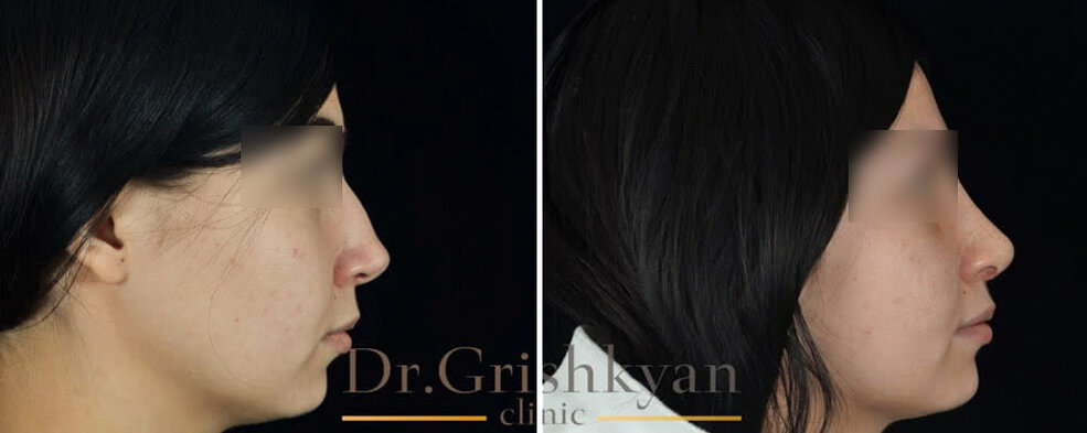 На фото слева неудачная пластика в другой клинике, справа - наша коррекция