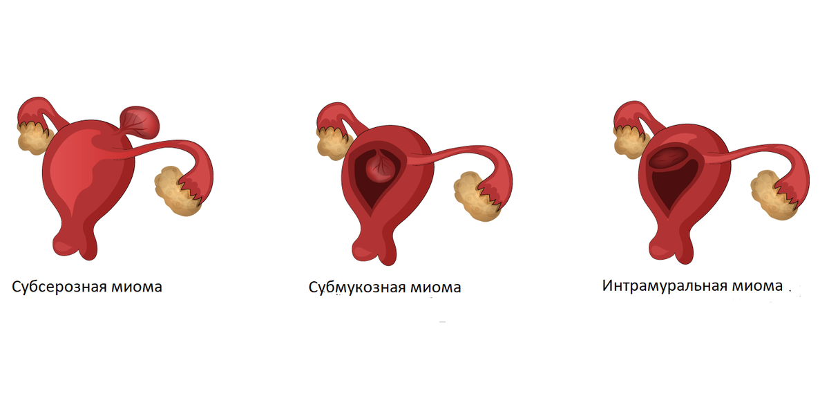 Расположение миоматозных узлов