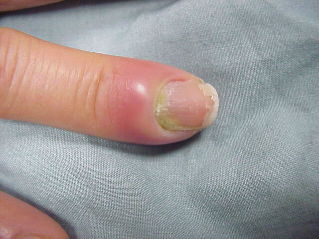 Трещины на пальцах рук: причины и лечение
