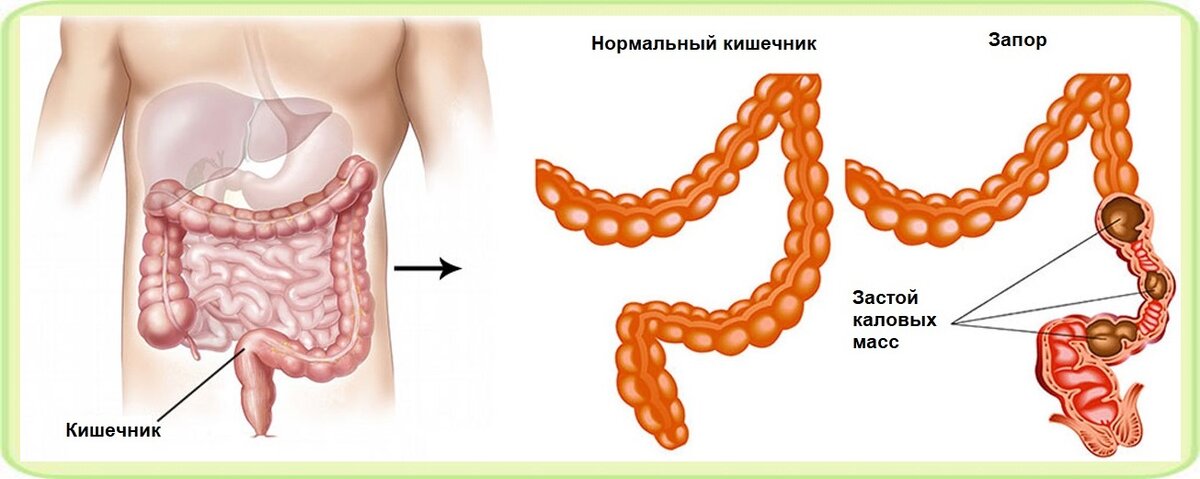 Запор у взрослых