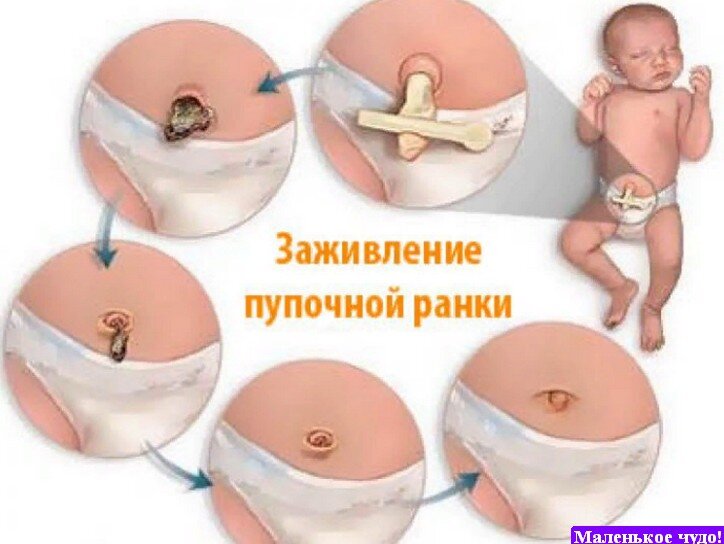 мокнет пупок у ребенка — 25 рекомендаций на manikyrsha.ru