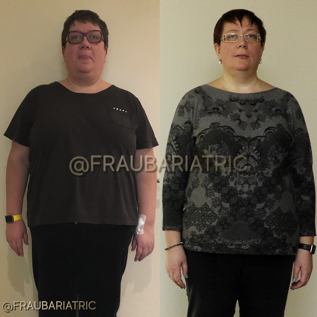 Бариатрическая операция ростов. Бариатрическая операция для похудения. До и после бариатрической операции. Бариатрия до и после фото.
