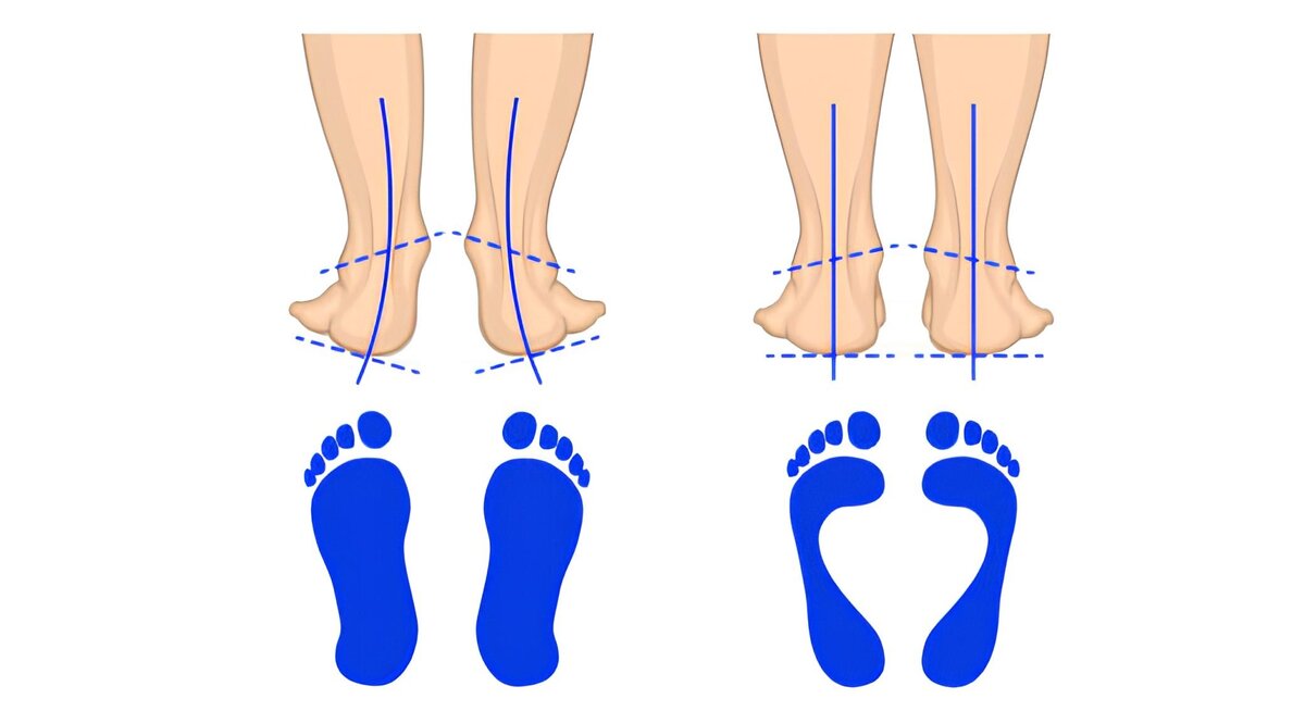 Варус вальгусная деформация. Эквиноварусная деформация стоп. Эквиноварусная деформация стопы.