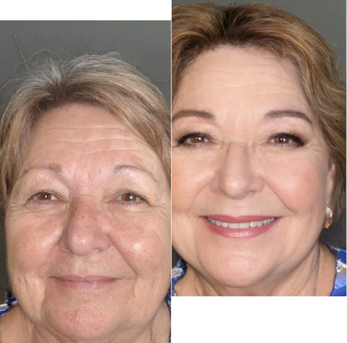 филлеры для лица. мезонити для подтяжки лица. макияж для возрастных женщин. омолаживающая маска. молодость кожи.