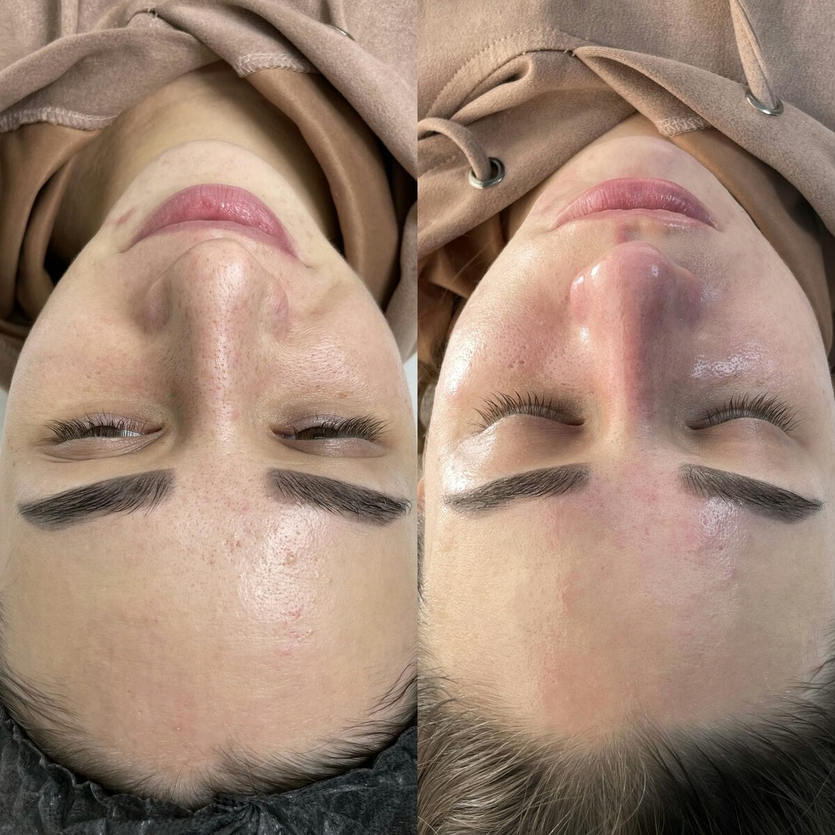 Фото слева до процедуры ультразвуковой чистки лица, фото справа - результат после процедуры.