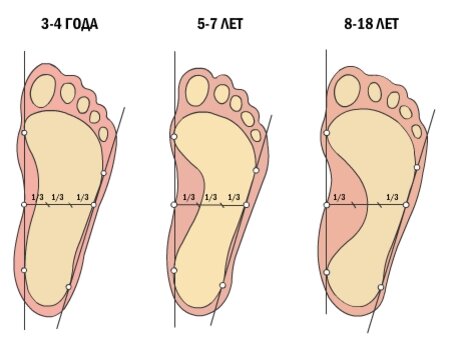 Причины плоскостопия у детей