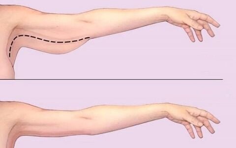 То, что показано на фото - это просто лишний жир, который убирается похудением.