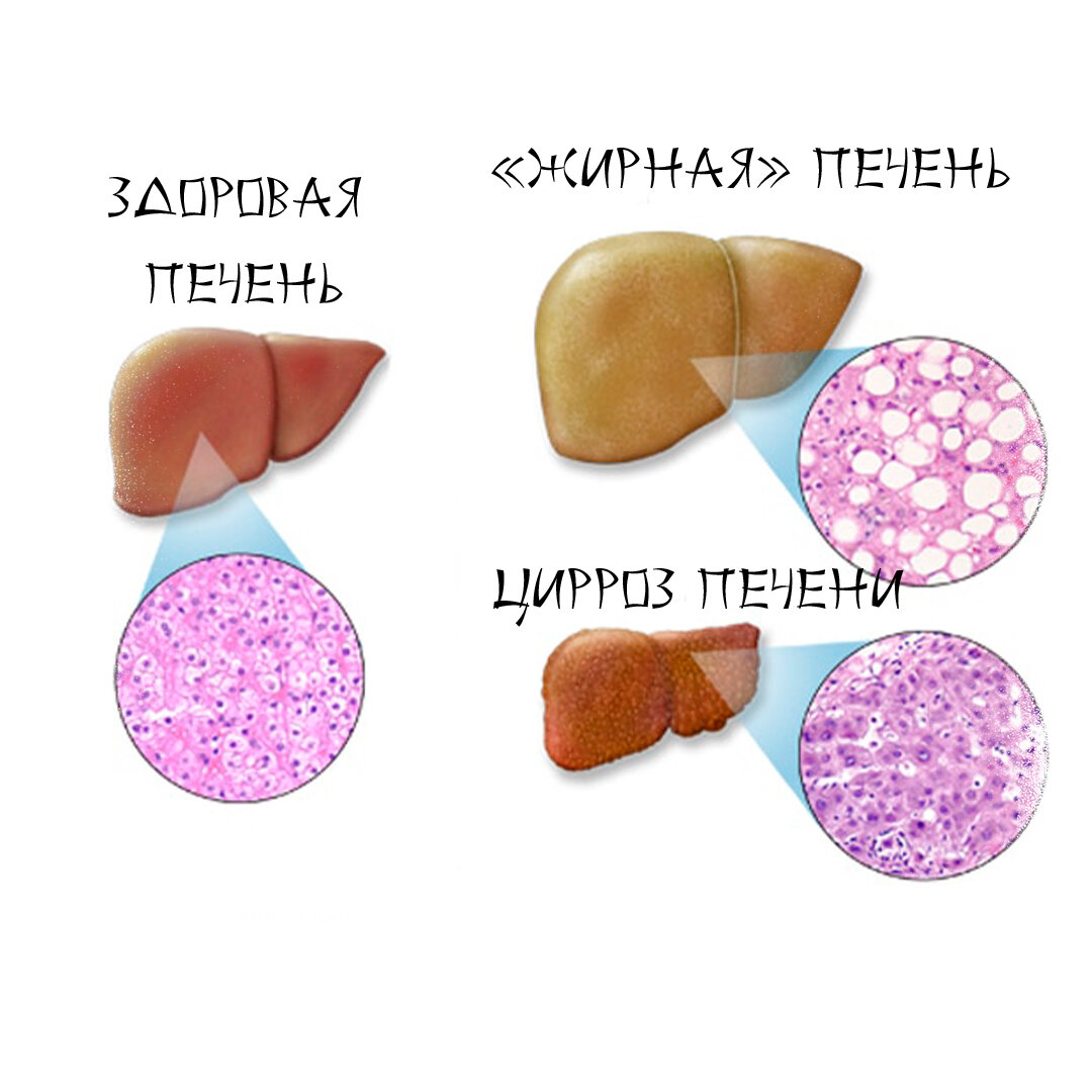 Здоровая и «больная» печень