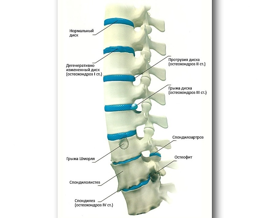 Спондилез l2 l4. Спондилоартроз th3-th12. Пояснично крестцовый спондилоартроз l1-s1. Протрузии дисков th3-th4.