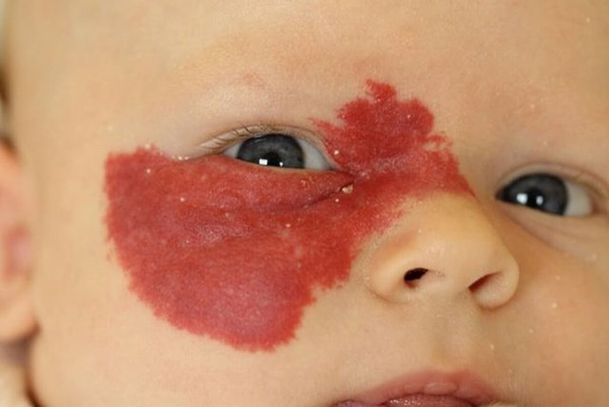 Гемангиома у младенца