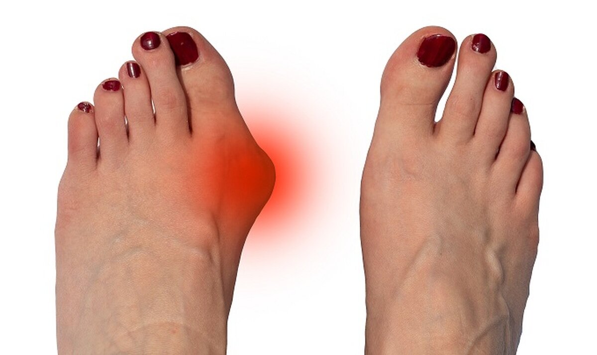 Hallux Valgus косточка на ноге встречается у женщин