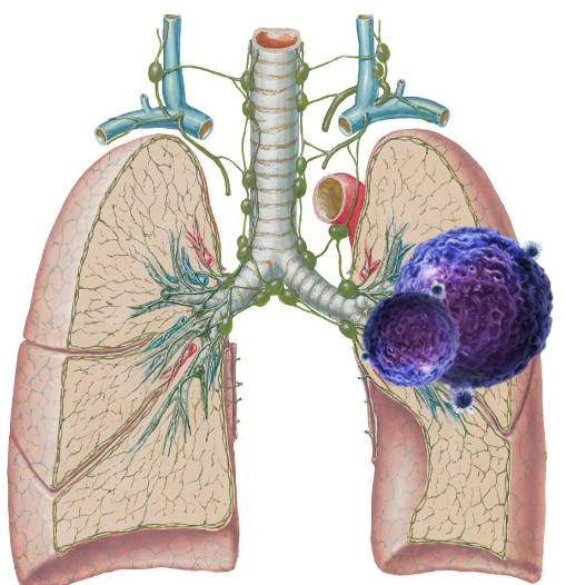 Рак легкого рисунок
