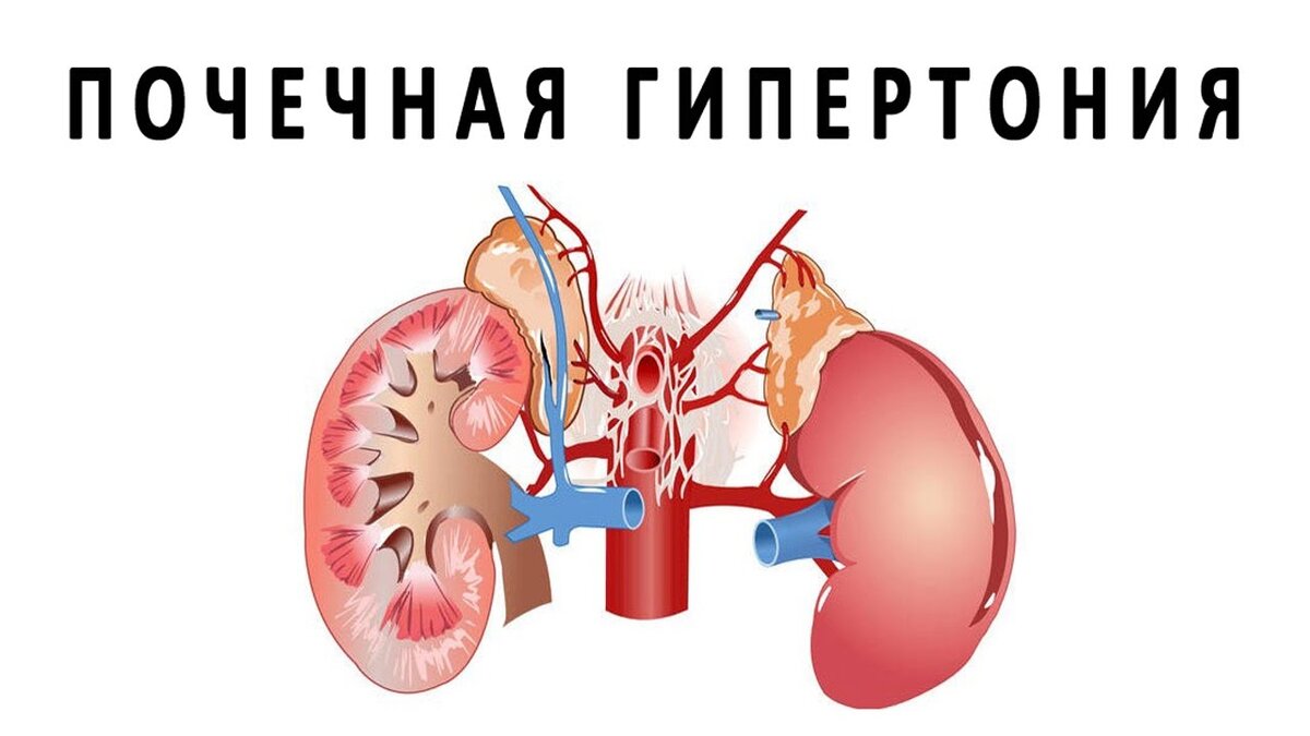 Почечная гипертония (вырезка из журнала 