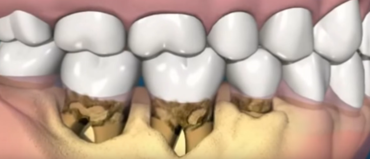 5 лучших способов отбеливания зубов в домашних условиях - Блог стоматологии санация