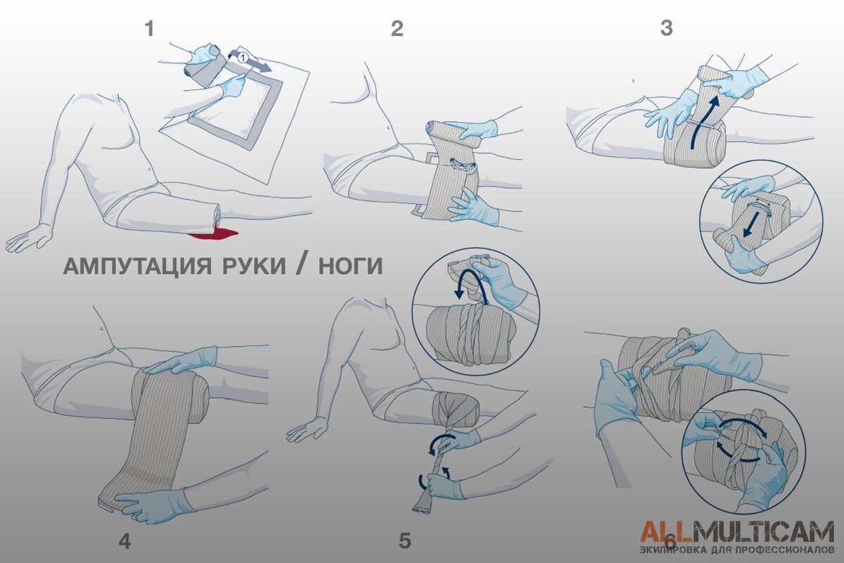 Травматическая ампутация голени карта вызова