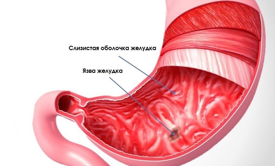 -2